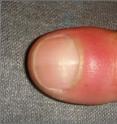 The classic symptoms of finger clubbing.