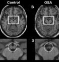 Brain scans reveal that the mammillary bodies (in box) of a sleep apnea patient (right) are smaller than those of a control subject (left).