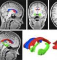 Top row -- three views of brain MRI images with the extracted brain structures highlighted. Bottom row -- MRI image with extracted brain structures (bottom left), two different close-up views of extracted brain structures (bottom middle and bottom right).