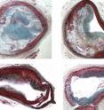 Plaques due to atherosclerosis in darapladib-treated vessels (bottom) are less severe and complex as compared to non-darapladib-treated control groups.