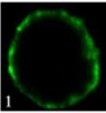 At left, a normal, uninfected cell with green-stained MHC-I protein on the cell surface. At right, an HIV infected cell -- most of the MHC-I builds up inside, keeping the cell from telling the immune system that it harbors a virus.