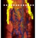 Cutaway OFDI image of a portion of a patient's right coronary artery, showing newly placed drug-eluting stent (dark blue), macrophages (green) and lipid deposits (yellow).