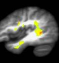 Yellow areas in the brain of a heavy marijuana smoker show brain regions with the most significant abnormalities. These areas correspond with those under development during normal adolescent years.