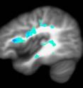 The blue areas mark the regions of most significant brain development in healthy older adolescents, as shown in diffusion tensor imaging.