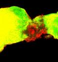 Tumorous glial cells, labeled in green, have overtaken most of an adult fly brain. Glial cell nuclei are shown in red.