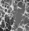 On the left is normal bone and on the right is osteoporotic bone.