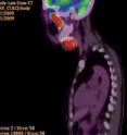 The patient shown in the PET/CT scan above has advanced head and neck cancer. The cancer is located primarily at the base of the skull (upper red area) and in the neck (lower red area).