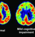 PET scans can detect the decline in glucose metabolism associated with decreased cognitive function, particularly in the temporal and parietal lobes located on the sides and the back of the brain, the regions associated with memory formation and language. UC Berkeley researchers are finding that brain imaging shows promise as a method of detecting early signs of Alzheimer's disease. On the left is a PET scan showing normal levels of glucose metabolism, indicated in yellow and red. The levels of glucose metabolism in the brain are decreased in patients with mild cognitive impairment (middle) and with Alzheimer's disease (right).