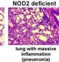 These are side-by-side cross-sections of virus-infected mouse lungs illustrate the critical role of the cellular molecule NOD2 in host defense. The cross-section on the left is from a normal mouse with healthy lungs; the one on the right is from a NOD2-deficient mouse with pneumonia.