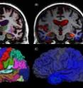 Serial MRI brain scans, taken six months apart, show progression from mild cognitive impairment to Alzheimer's disease, with significant atrophy (blue) and ventricle enlargement (orange/red).