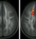 The left brain image shows the area of compromised white matter (blue area) among poor readers relative to good readers at the beginning of the study.
THe center brain image shows the area where the structural integrity increased (red/yellow area) among poor readers who received the instruction, and it is very similar to the initially compromised area.
The right brain image shows that following the instruction, there were no differences between the good and poor readers with respect to the integrity of their white matter.