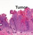 This is Normal skin (Norm) with an adjacent squamous cell carcinoma (Tumor).