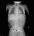 This is an X-ray of a two-year-old boy after swallowing a battery from a Christmas ornament. The X-ray shows the battery (indicated by arrow) has moved into the colon.