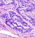 This is a histopathologic image of a colonic carcinoid stained by hematoxylin and eosin.