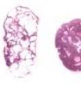 On the left is a normal mouse kidney. In the center is a polycystic mouse kidney. On the right is a polycystic mouse kidney after treatment with rapamycin.