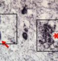 The toxic form of Elk-1 is present in plaque found in brain tissue from an Alzheimer disease patient (red asterisk). A neuronal process of a dying neuron is denoted by the red arrow.