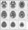 These are eLORETA images of sources of alpha EEG during TM compared to eyes-closed rest in the default mode network (the white areas).