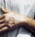 This is a skin ulcer caused by leishmaniasis, one of a terrible trio of parasitic diseases -- along with Chagas disease and sleeping sickness -- that are the target of a three-in-one test.
