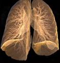 University of Iowa researchers have shown that CT scans measuring blood flow in the lungs can detect early emphysema-related changes that occur in smokers who are susceptible to the disease. This image shows the lungs of a patient who smokes and has very early signs of emphysema.