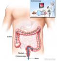 In a colonoscopy, a colonoscope is inserted through the anus and rectum and into the colon. The inset shows a patient on a table having a colonoscopy.