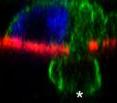 An actin-rich invadopodium pushes through the basement membrane (red, left), allowing the tumor cell to follow (right).