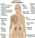 This graphic displays the various symptoms related to fibromyalgia.