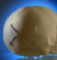 A degradable implant closes the fissures in the cranial region. It was designed by Karl Leibinger Medizintechnik company. It was manufactured at Fraunhofer ILT.