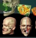 Using engineering design methods, researchers model custom bone replacement implants for facial reconstruction surgery.