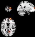 These are views of inflated cortical surface showing areas of brain gray matter correlating with
introspective accuracy.