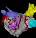 This is a CARTO3 map of the left atrium with pulmonary veins and location of ablation lesions.