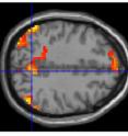 The image represents the areas that the children with ADHD failed to deactivate during the low incentive condition, as compared with the control children (who showed no difference between incentive conditions).