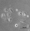 This image shows mesenchymal cells after being treated with miR-429. They look more like primary tumor cells.