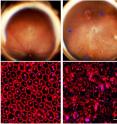 Geographic atrophy is induced by DICER1 reduction as seen in the retinal photograph (top right, blue arrowheads). This is prevented by blocking Alu RNA (top left). Flat mount pictures show that the degeneration of the RPE cells induced by DICER1 reduction (bottom right) is prevented by blocking Alu RNA (bottom left).