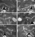 The Stripe of Gennari (right: subjects with normal vision, left: blind subjects) shows up as a thin dark line in the sulcus calcinarus (white) which surrounds the primary visual cortex.