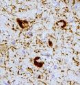 Tau protein modified by acetylation is detected in neurofibrillary tangles from brains of patients with Alzhiemer's disease.