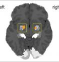 This image shows amygdala activation during listening to improvised melodies (compared to listening to imitated melodies).