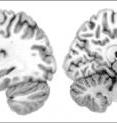 This image shows increased activation in the frontal operculum (left), the pre-supplementary area (middle) and the anterior insula (right) when listening to melodies judged as being improvised.