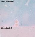 Minihepcidin treatment prevents liver iron loading in mice with hereditary hemochromatosis. The top panel shows a liver section from a mouse treated with placebo only, and the bottom panel shows a liver section from a mouse treated with minihepcidin. Blue color reveals iron deposits, pink color identifies cells with low iron content. Treatment with minihepcidin for two weeks prevented harmful accumulation of iron in the liver.