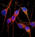 Stem-cell-derived neurons, made from patients with Alzheimer's disease, provide a new tool for unraveling the mechanisms underlying the neurodegenerative disease. In this image, DNA is shown in blue, dendrites and cell bodies in red and endosomal markers Rab5 and EEA1 in green and orange, respectively.