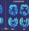 These are baseline and follow-up brain scans of a patient who converted to Alzheimer's disease after two years (images to right of white line) that shows high medial temporal binding at baseline (lower left) and follow-up (lower right), but also demonstrates more baseline binding in frontal (upper images) and lateral temporal regions.  Warmer colors (yellows, reds indicate higher binding levels.  A second patient did not convert to Alzheimer's after two years (images to left of white line) showing medial temporal (lower scans), but very mild frontal (upper scans) binding at baseline and follow-up.