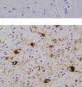 These images show the brainstem from a control animal (top) and an animal injected with pathologic alpha-synuclein. Brown spots are immunostaining using an antibody specifically recognizing an abnormal form of alpha-synuclein.