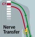 To detour around the block in this patient's C7 spinal cord injury and return hand function, Mackinnon operated in the upper arms. There, the working nerves that connect above the injury (green) and the non-working nerves that connect below the injury (red) run parallel to each other, making it possible to tap into a functional nerve and direct those signals to a non-functional neighbor (yellow arrow).