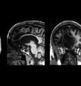 Researchers at the University of Iowa studied the brain of a patient with rare, severe damage to three regions long considered integral to self-awareness in humans (from left to right: the insular cortex, anterior cingulate cortex, and the medial prefrontal cortex). Based on the scans, the UI team believes self-awareness is a product of a diffuse patchwork of pathways in the brain rather than confined to specific areas.