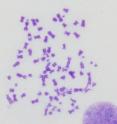 A <em>JCB</em> study determined how BRCA1-deficient cells protect themselves from genomic instability. The cells can accumulate fused and broken chromosomes (see image) because they can’t use homologous recombination to repair their DNA. But the cells can resume proliferation by cranking up their output of cathepsin L, which destroys 53BP1, a protein that prods the cells to use alternative, sloppier repair mechanisms.