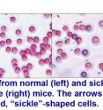 Normal (left) and sickle cell (right) mouse red blood cells show the rigid, crescent-shaped "sickled" cells (arrows).