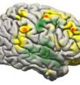 This image shows the changes that took place in the brain for all patients participating in the study using a brain-computer interface. Changes in activity were distributed widely throughout the brain.