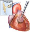 The waterproof, light-activated glue developed by researchers at Brigham and Women's Hospital, Boston Children's Hospital and Massachusetts Institute of Technology can successfully secure biodegradable patches to seal holes in a beating heart.