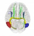 This is a 3D image showing some of the aberrant interhemispheric bundles in a "glass brain" of a subject born without the corpus callosum. In yellow, the aberrant midbrain bundle that connects the right (in blue) and left (in red) brain hemispheres.