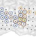 This is a 3-D image of the left brain hemisphere of a patient with tinnitus (right) and the part of that hemisphere containing primary auditory cortex (left). Black dots indicate all the sites recorded from. Colored circles indicate electrodes at which the strength of ongoing brain activity correlated with the current strength of tinnitus perceived by the patient. Different colors indicate different frequencies of brain activity (blue = low, magenta = middle, orange = high) whose strength changed alongside tinnitus. Green squares indicate sites where the interaction between these different frequencies changed alongside changes in tinnitus.