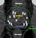 Radiation dose is delivered by beams directed from many angles combined with implanted seeds (white spots). By integrating the two types of radiation, the highest dose is delivered only within the tumor. The external beams correct any irregularity from the seeds. Thanks to MRI planning, very little dose goes to critical adjacent structures.